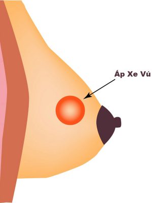 Áp xe vú có thề dẫn tới biến chứng nguy hiểm