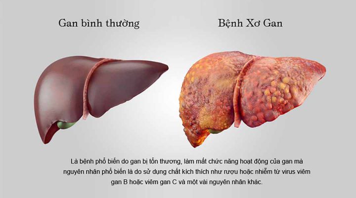 Uống nhiều rượu bia là một nguyên nhân dẫn tới xơ gan