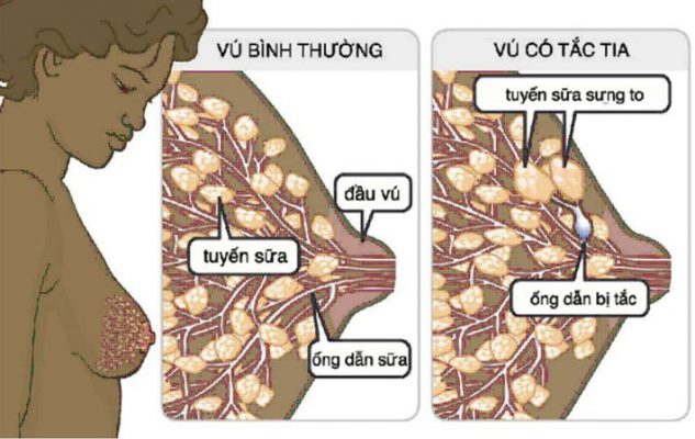 Tắc tia sữa là hiện tượng thường gặp ở mẹ sau sinh