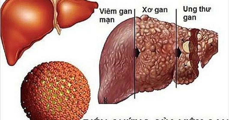 Có nhiều nguyên nhân dẫn tới ung thư gan