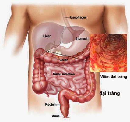 Viêm đại tràng là bệnh thường gặp trong xã hội hiện nay