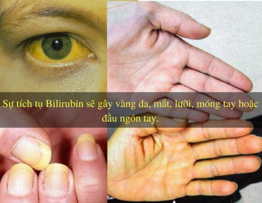 Nồng độ Bilirubin trong máu tăng cao dẫn đến vàng da, vàng mắt