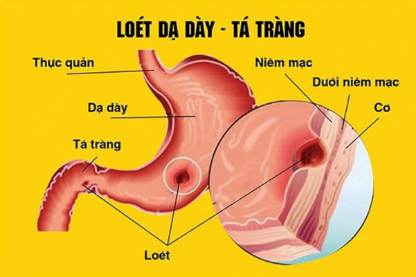 Viêm loét dạ dày gây ảnh hưởng nghiêm trọng tới sưc khỏe của người bệnh