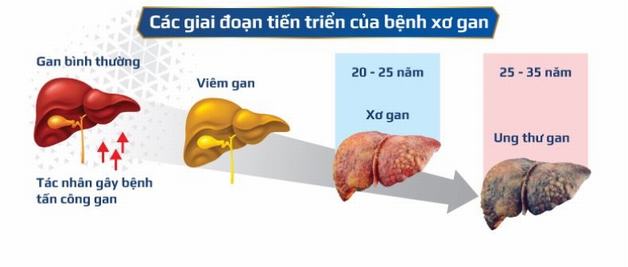 Các giai đoạn phát triển của bệnh xơ gan