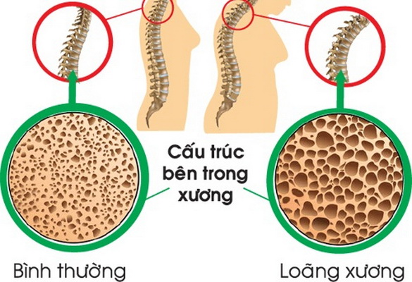 Loãng xương là một trong những nguyên nhân gây ra yếu xương cốt