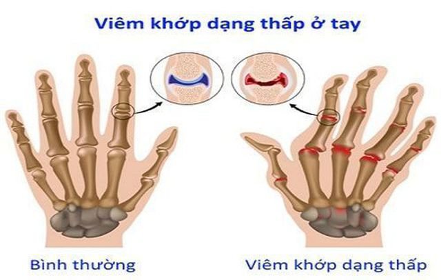 Viêm khớp dạng thấp là nguyên nhân gây đau nhức xương khớp