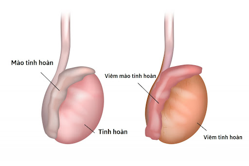 Viêm tinh hoàn là bệnh thường gặp ở nam giới