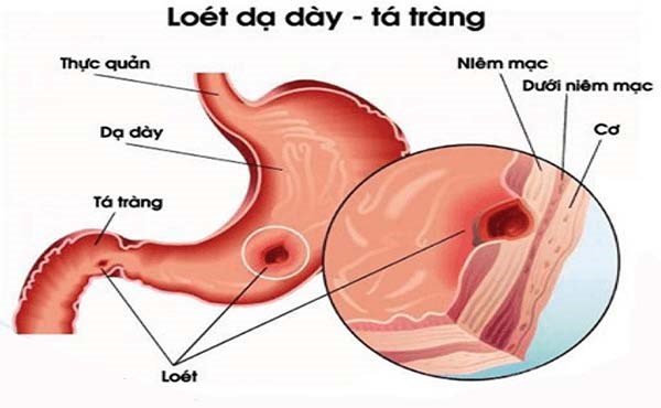 Đau dạ dày là bệnh đường ruột phổ biến ở mọi lứa tuổi