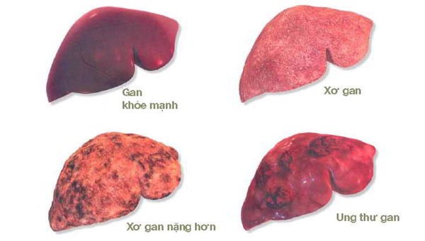 Các biến chứng của bệnh gan