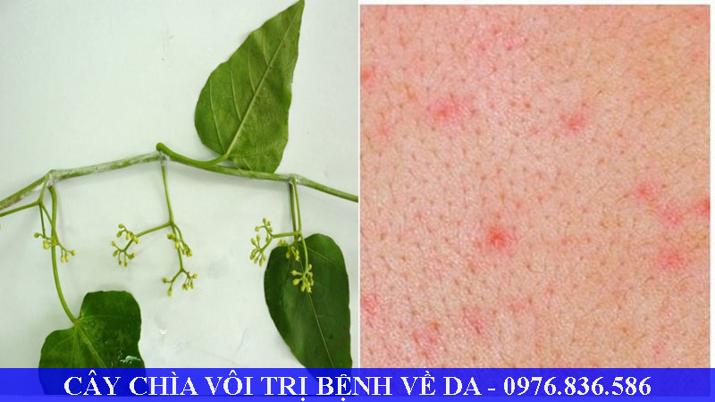 Cây chìa vôi trị các bệnh về da hiệu quả