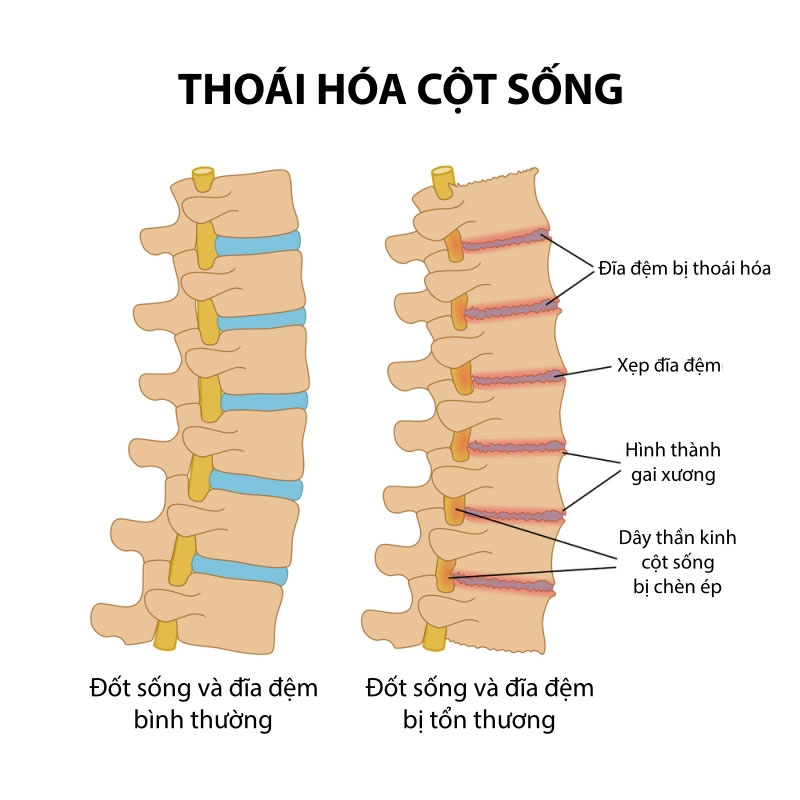 Thoái hóa cột sống là bệnh thường gặp trong xã hội hiện nay