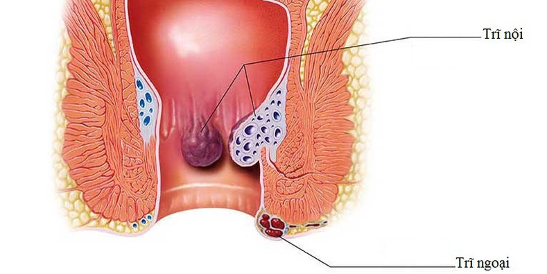 Bệnh trĩ gây nhiều khó chịu cho người bệnh