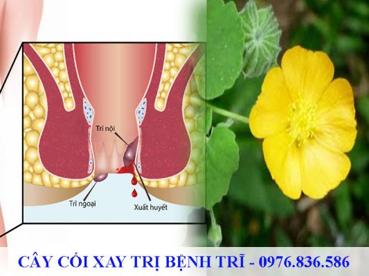 Cây cối xay hỗ trợ điều trị bệnh trĩ