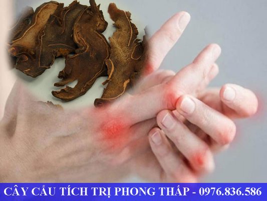 Phong thấp gây đau nhức ở các khớp