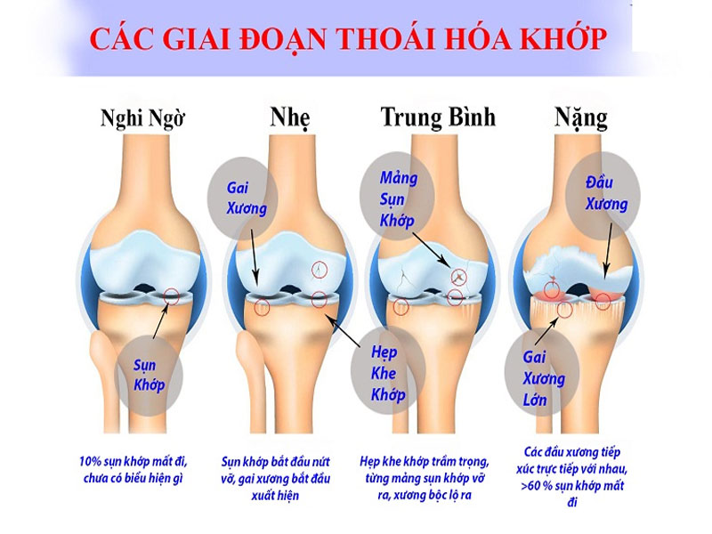 Các giai đoạn của thoái hóa khớp