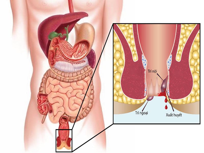 Bệnh trĩ gây nhiều khó chịu trong sinh hoạt hàng ngày của bệnh nhân