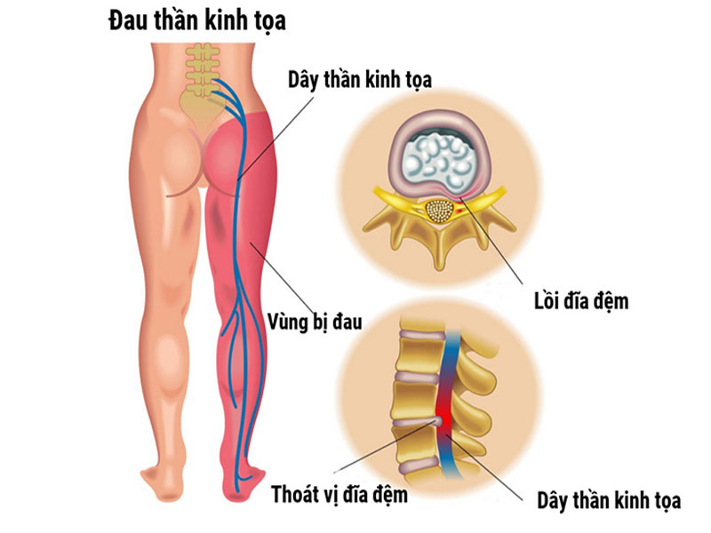 Đau thần kinh tọa gây nhiều ảnh hưởng tới vận động của người bệnh