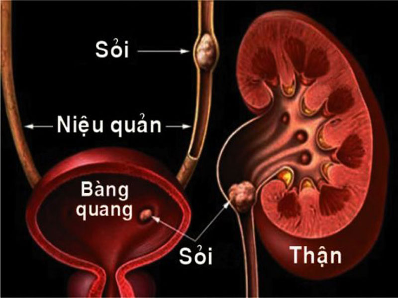 sỏi tiết niệu bao gồm sỏi thận, sỏi niệu quản, sỏi bàng quang và sỏi niệu đạo