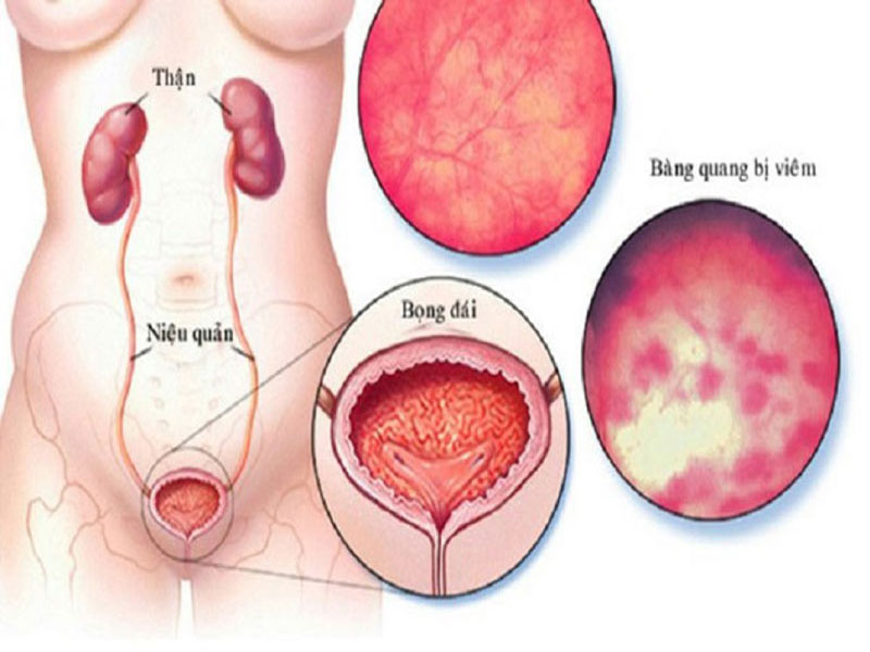 Viêm bàng quang thường gặp ở phụ nữ nhiều hơn nam giới