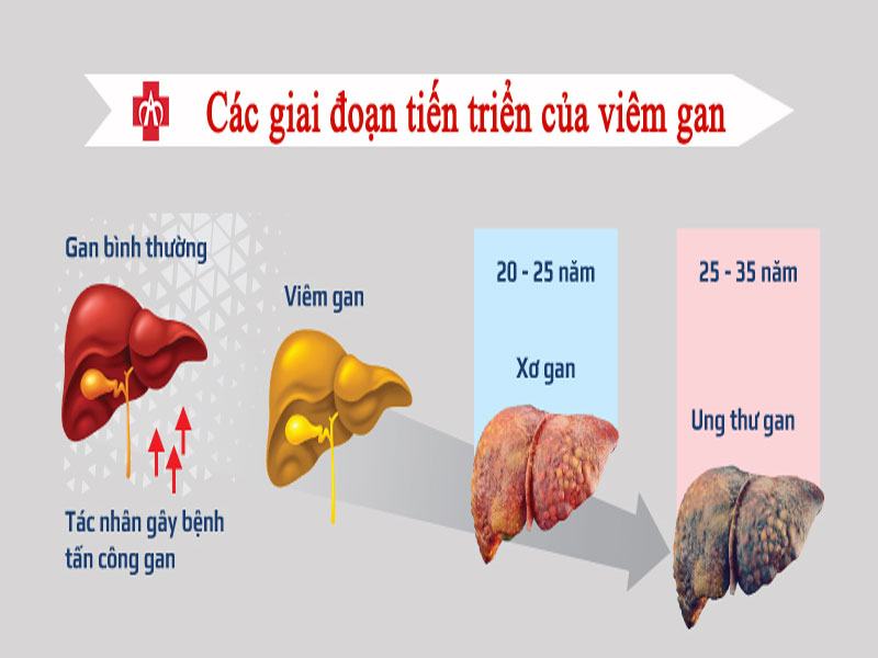 Viêm gan siêu vi có thể gây các biến chứng nguy hiểm đối với sức khỏe