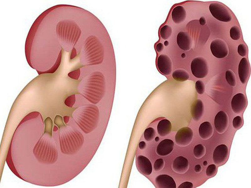 Bệnh thận thường không gây ra triệu chứng gì cho tới khi đã tiến triển