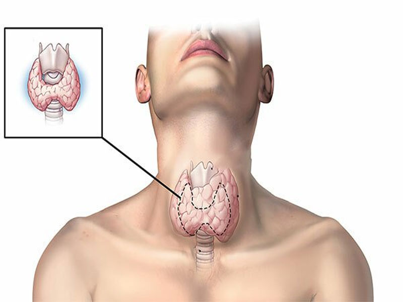 Thiếu Iod là một trong các nguyên nhân gây bướu cổ