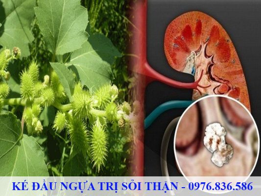 Ké đầu ngựa hỗ trợ điều trị sỏi thận