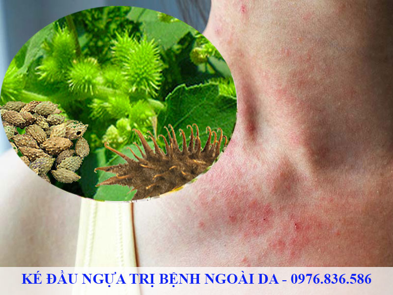 Ké đầu ngựa trị bệnh về da