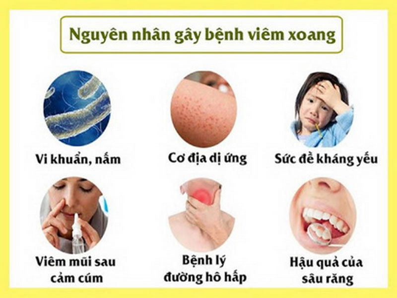 Nguyên nhân gây viêm xoang