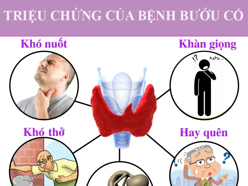 Triệu chứng của bệnh bướu cổ