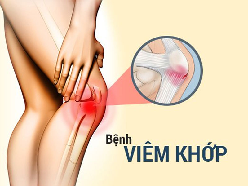 Đau nhức xương khớp có thể do nguyên nhân từ bệnh viêm khớp