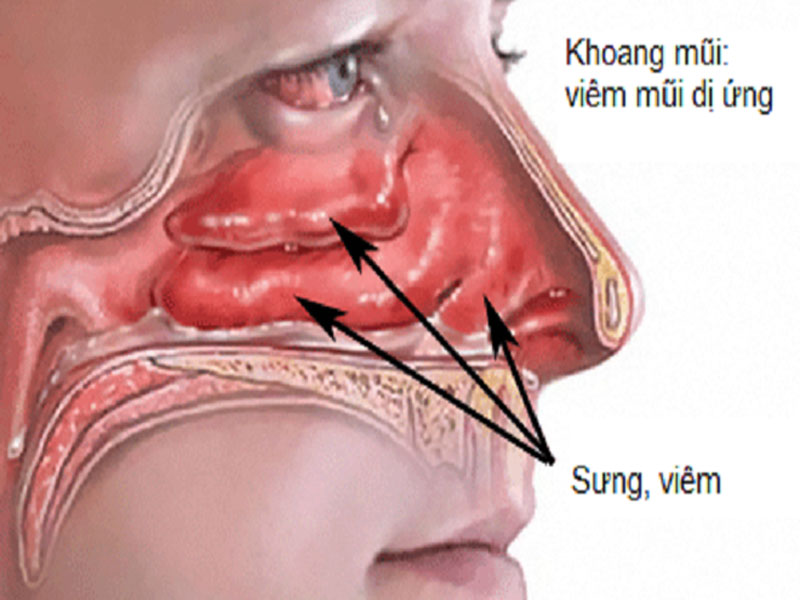 Viêm mũi dị ứng thường gặp khi thời tiết giao mùa